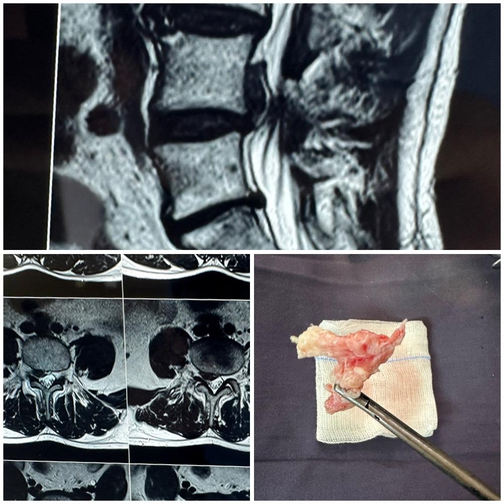 Complex Spine Surgery - Decompression and Fusion
